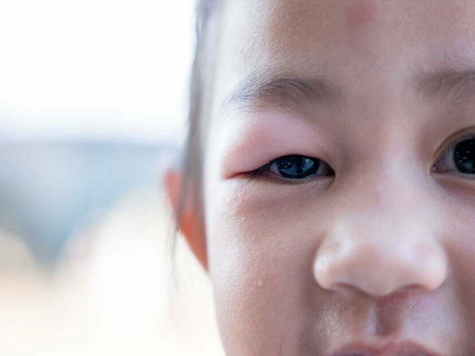 Children's Stye | Causes, Symptoms & Treatment for a Child's Stye