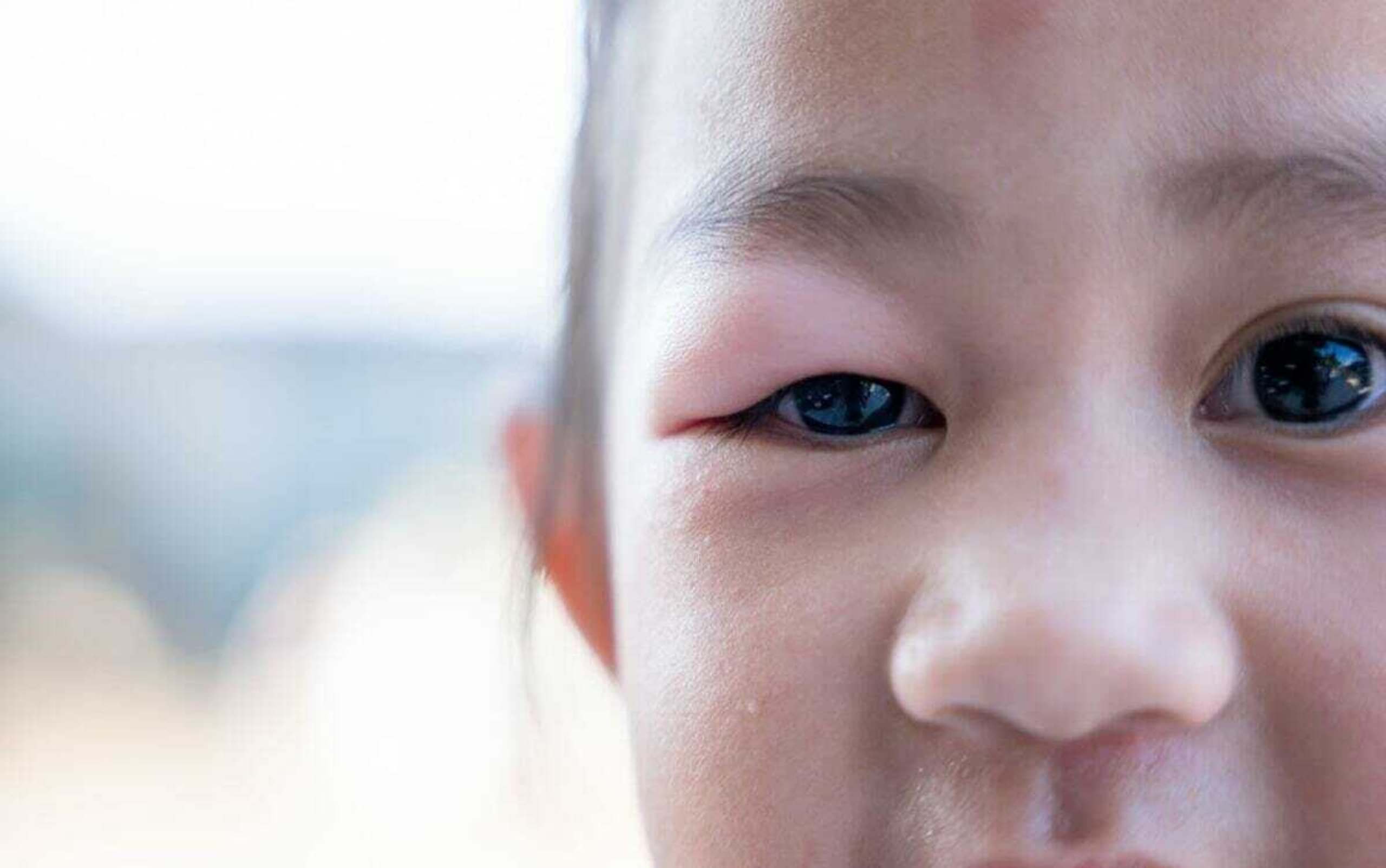 Children's Stye | Causes, Symptoms & Treatment for a Child's Stye