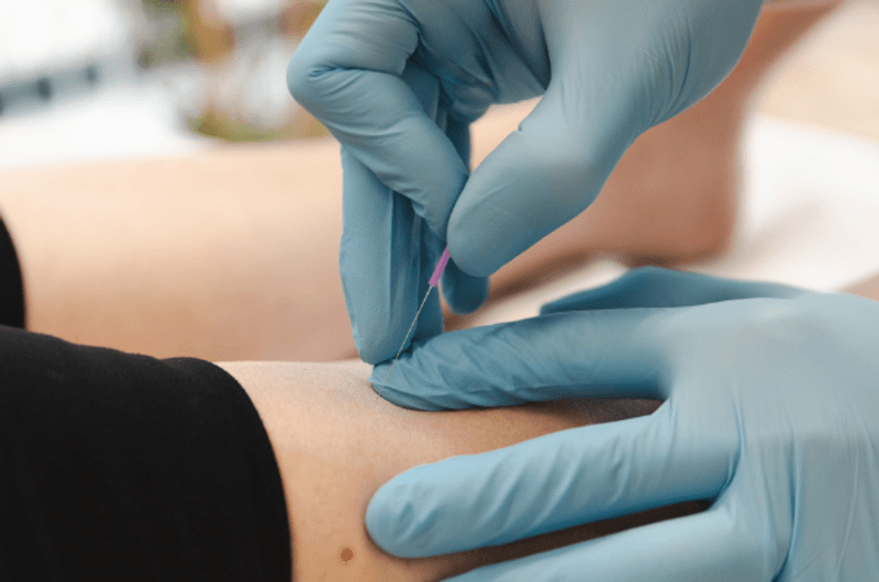 Needle Your Way to Peak Performance: Exploring the Benefits of Acupuncture for Sporting Professionals and Weekend Warriors