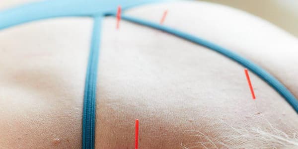 Acupuncture