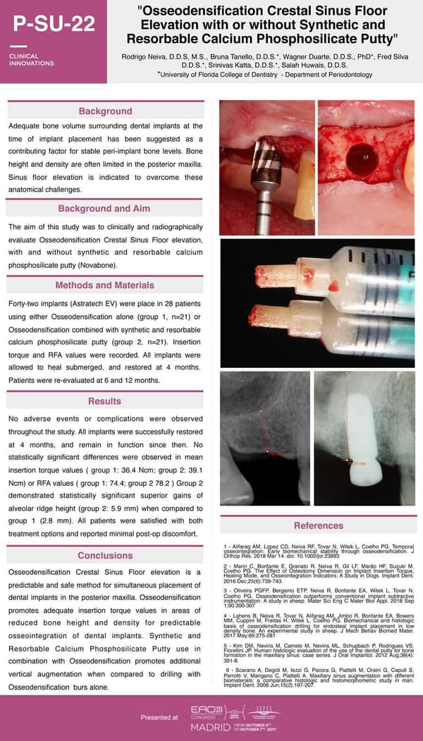 Osseodensification Crestal Sinus Floor Elevation With Osteogenics