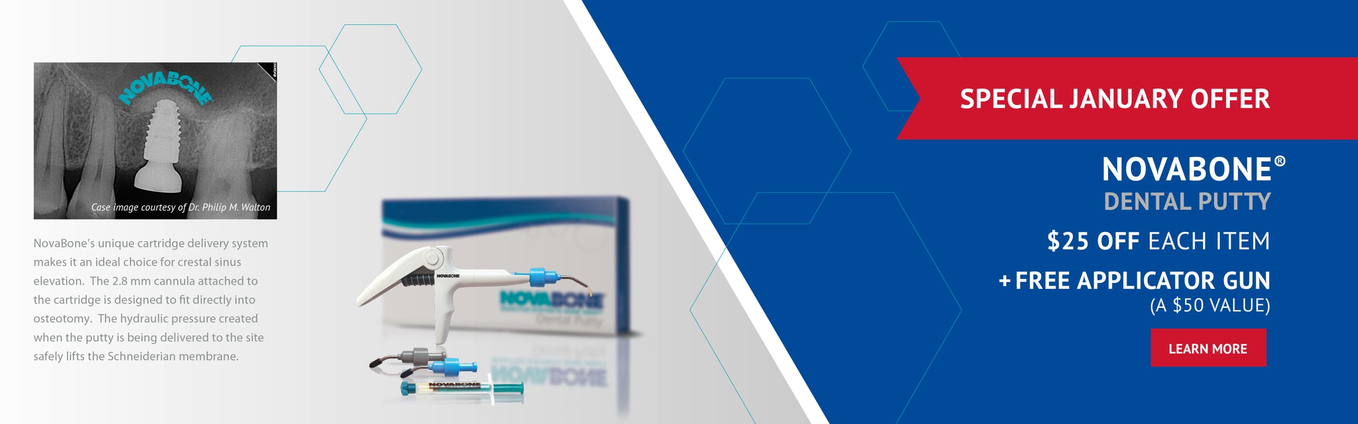 Osteogenics Guided Bone Regeneration and Guided Tissue Regeneration