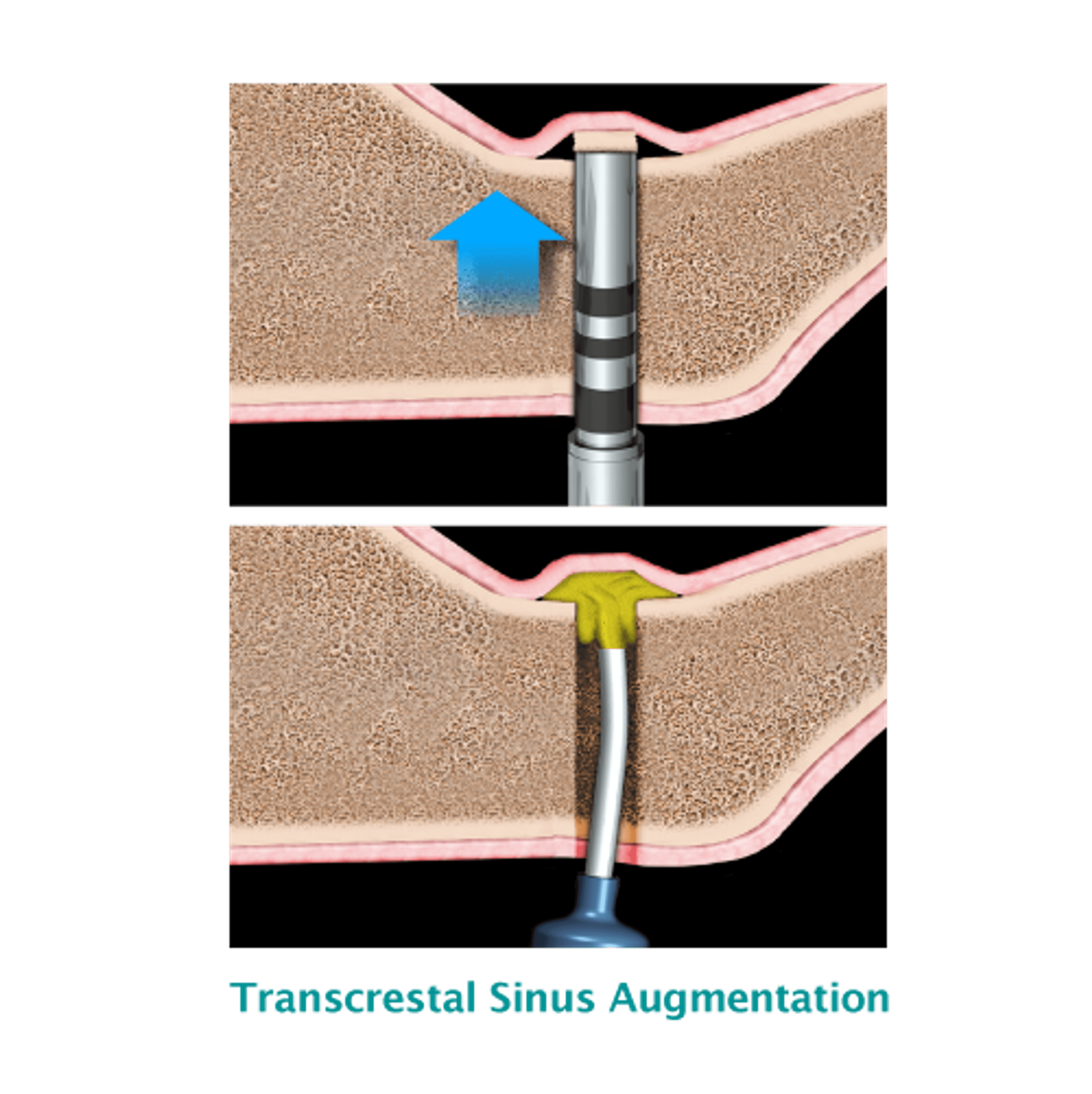 Novabone NovaBone® Dental Putty in Cartridges - Osteogenics