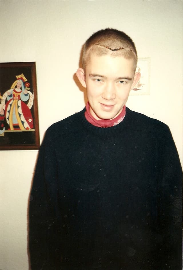 Chris following his Anterior Fosa-Craniotomy.
