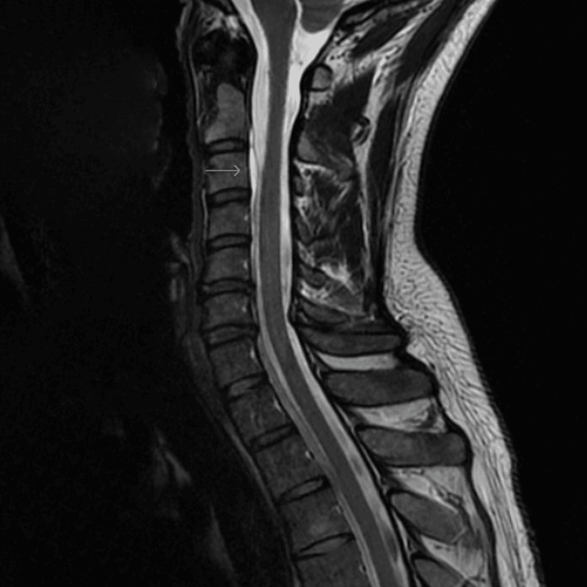 Medical MRI scan revealing a thoracic spinal CSF leak.