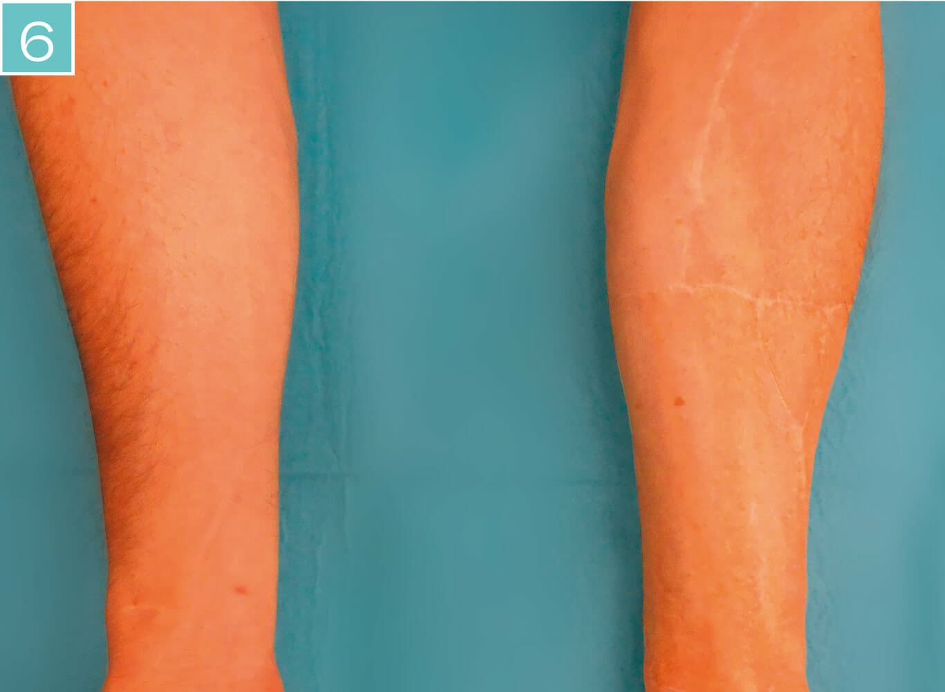 L01 DS212621 Matri Derm Materials Donor Site 6