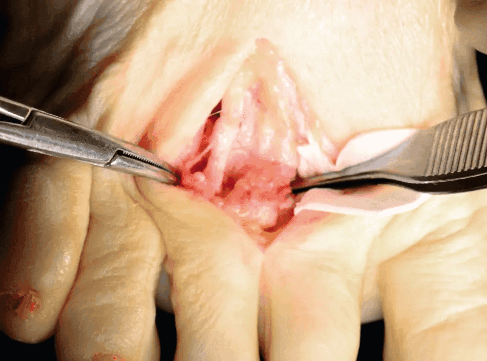 Matri Derm Case Adhesion Barrier 01