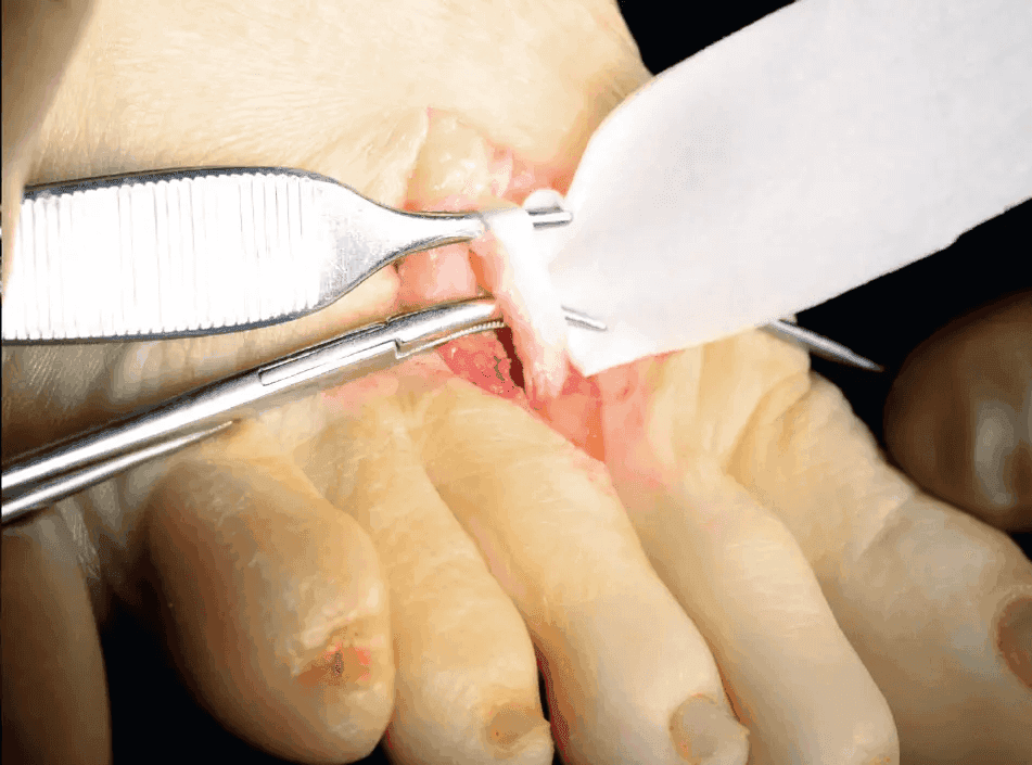 Matri Derm Case Adhesion Barrier 02