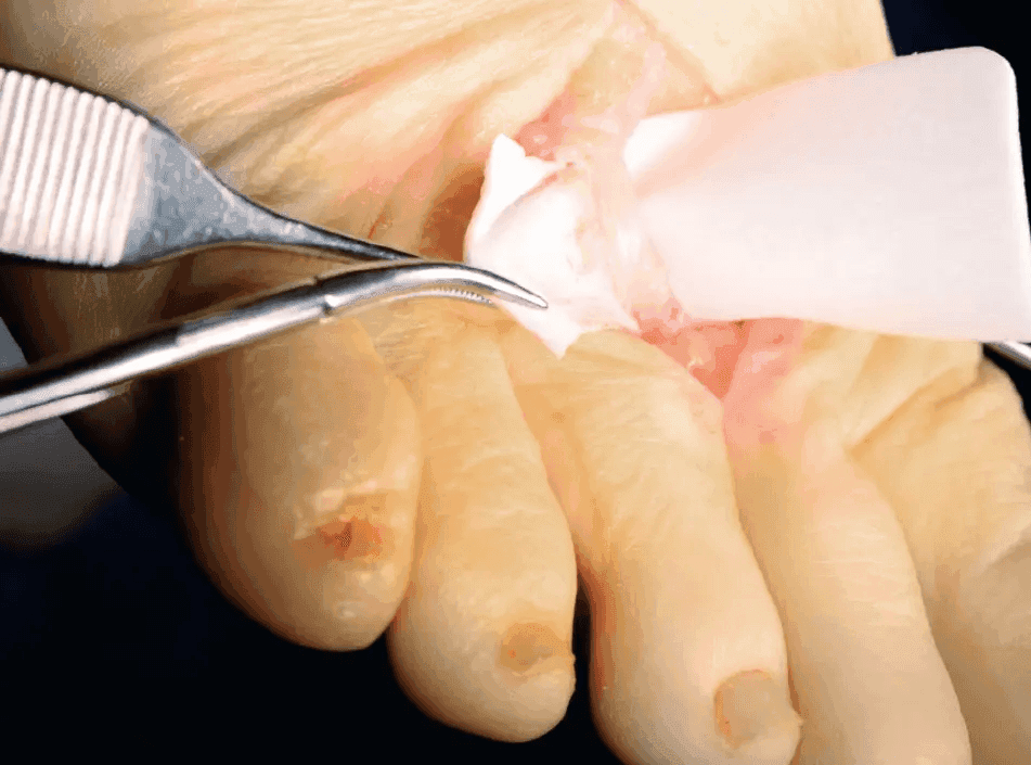 Matri Derm Case Adhesion Barrier 03
