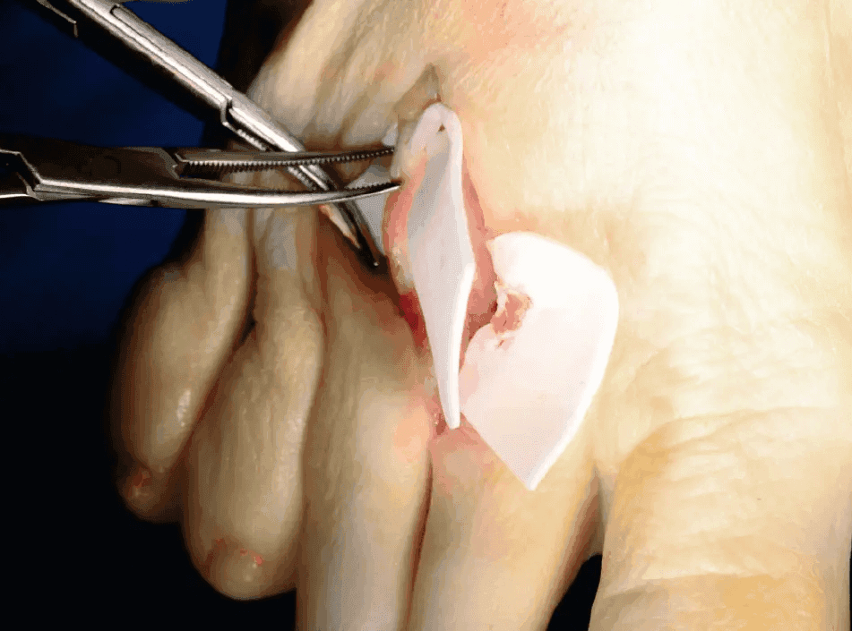 Matri Derm Case Adhesion Barrier 04