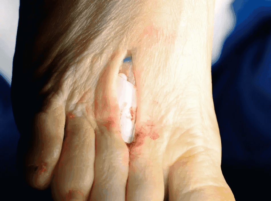 Matri Derm Case Adhesion Barrier 05