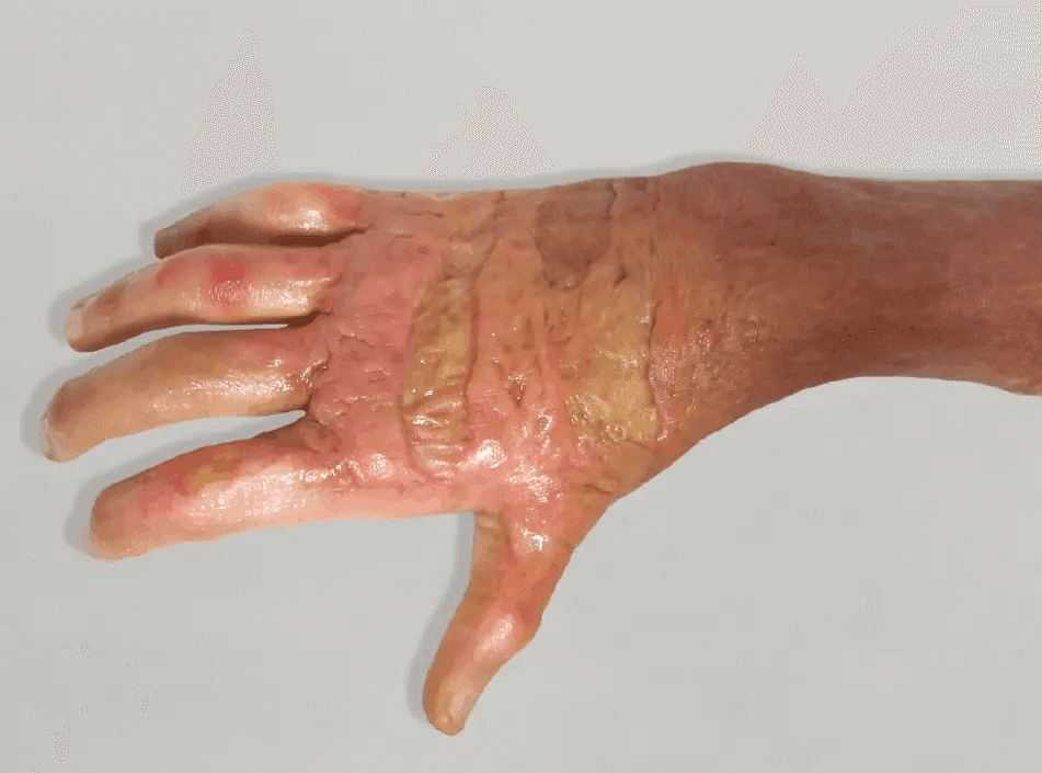 Matri Derm Case Burns 01