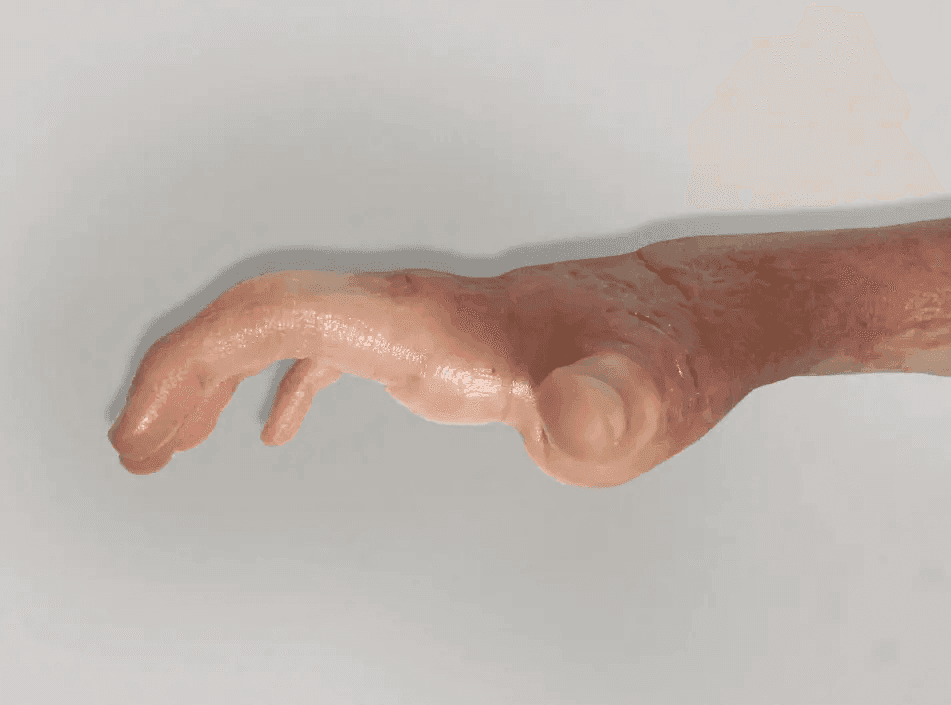 Matri Derm Case Burns 02