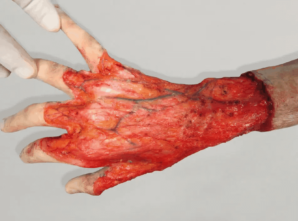 Matri Derm Case Burns 03