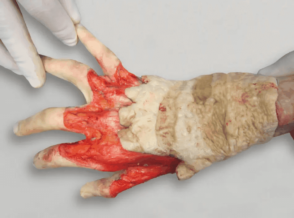 Matri Derm Case Burns 04