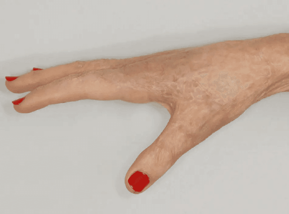 Matri Derm Case Burns 08