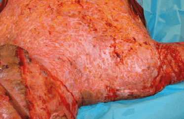 Matri Derm Case Burns Acute 01