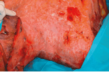 Matri Derm Case Burns Acute 02