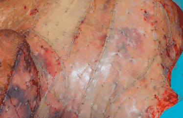 Matri Derm Case Burns Acute 03