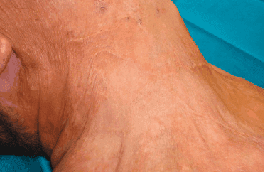 Matri Derm Case Burns Acute 04