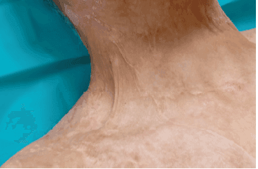 Matri Derm Case Burns Acute 06