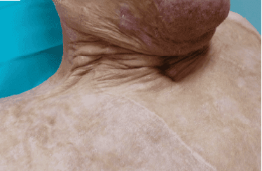 Matri Derm Case Burns Acute 07