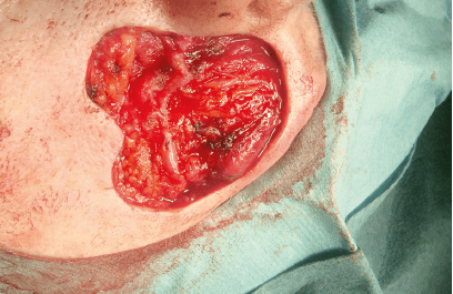 Matri Derm Case Cancer 01