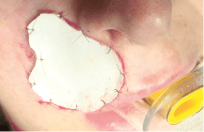 Matri Derm Case Cancer 02
