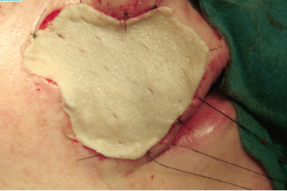 Matri Derm Case Cancer 03