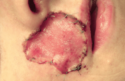 Matri Derm Case Cancer 04