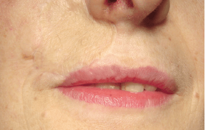 Matri Derm Case Cancer 05