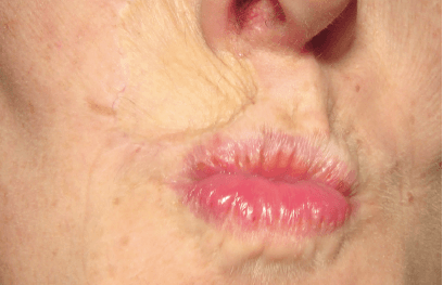 Matri Derm Case Cancer 07