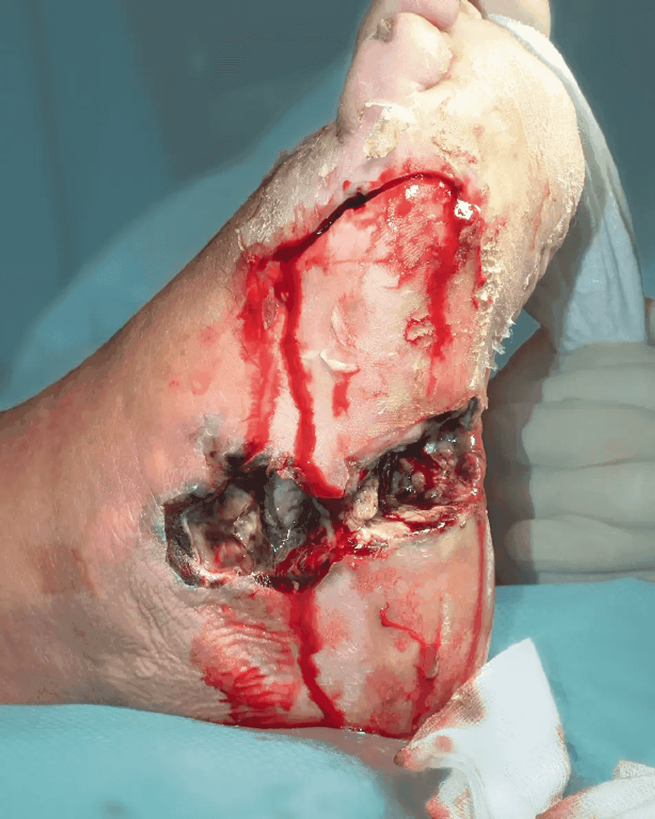 Matri Derm Case Chronic Wounds 01