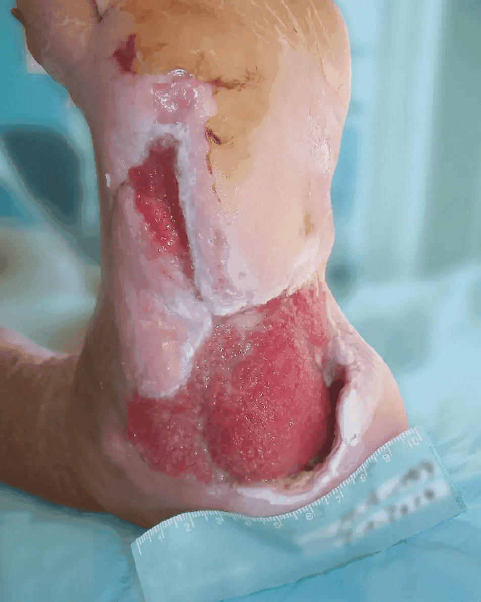 Matri Derm Case Chronic Wounds 02