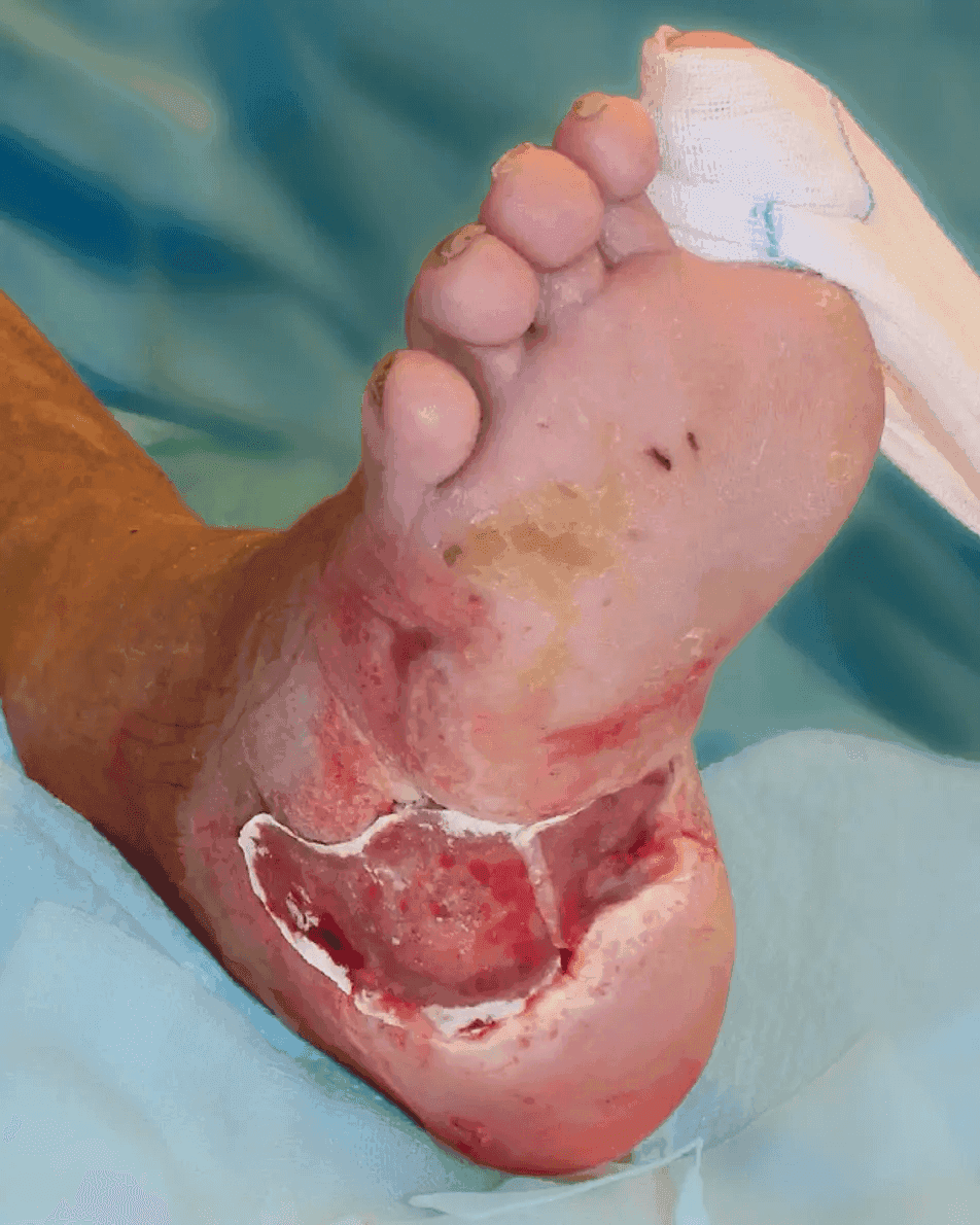 Matri Derm Case Chronic Wounds 03