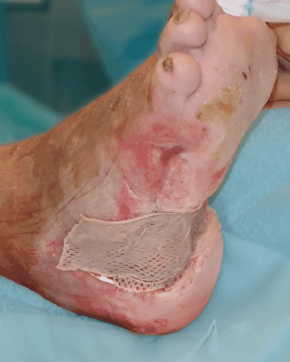 Matri Derm Case Chronic Wounds 04