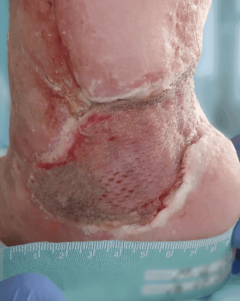 Matri Derm Case Chronic Wounds 05