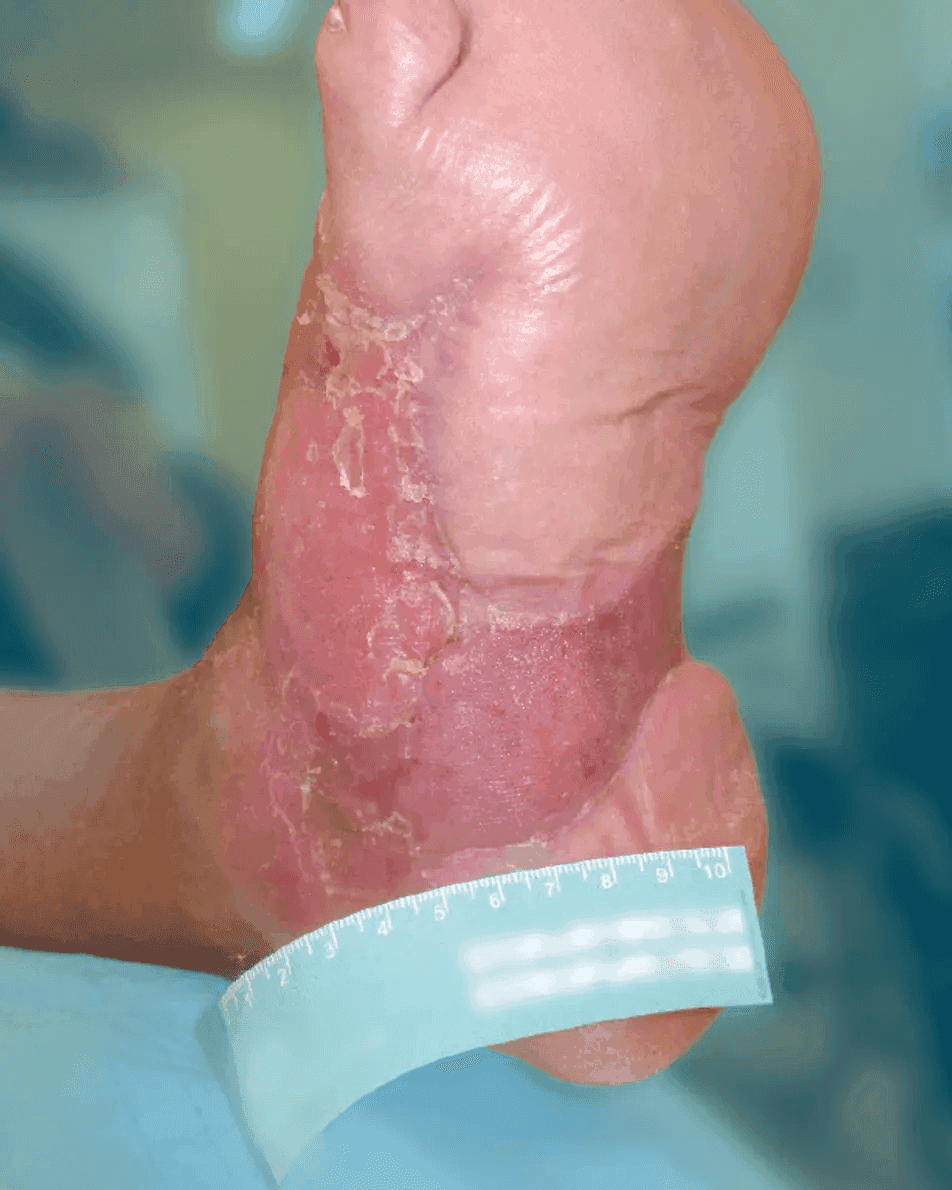 Matri Derm Case Chronic Wounds 07