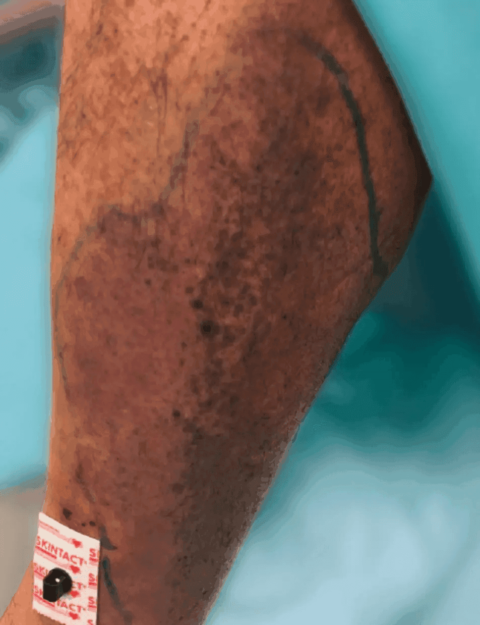 Matri Derm Case Trauma 01