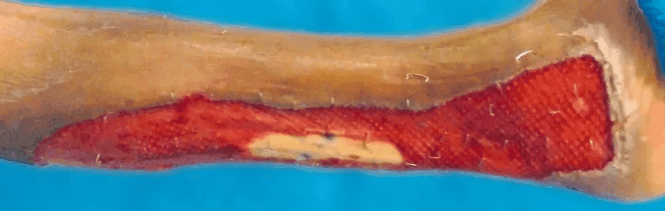 Matri Derm Case Trauma 06 1