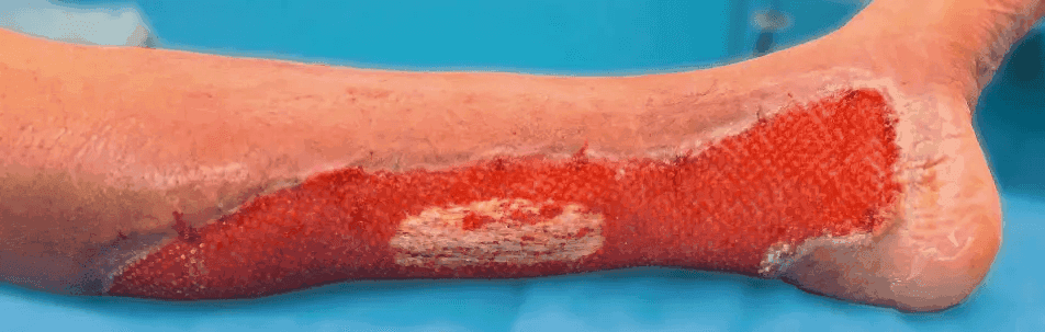Matri Derm Case Trauma 07