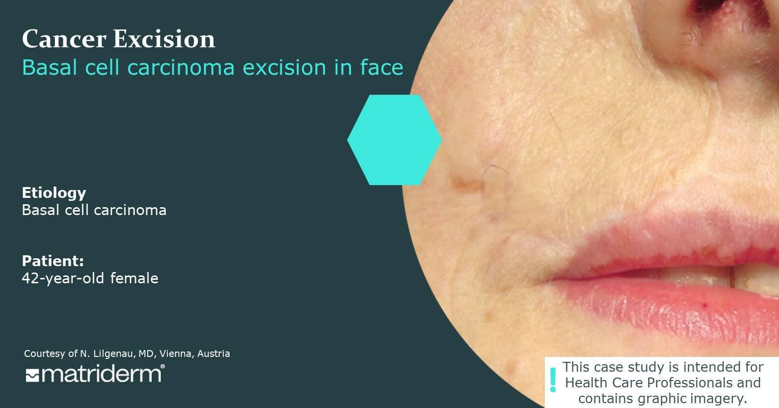 Poster cancer excision