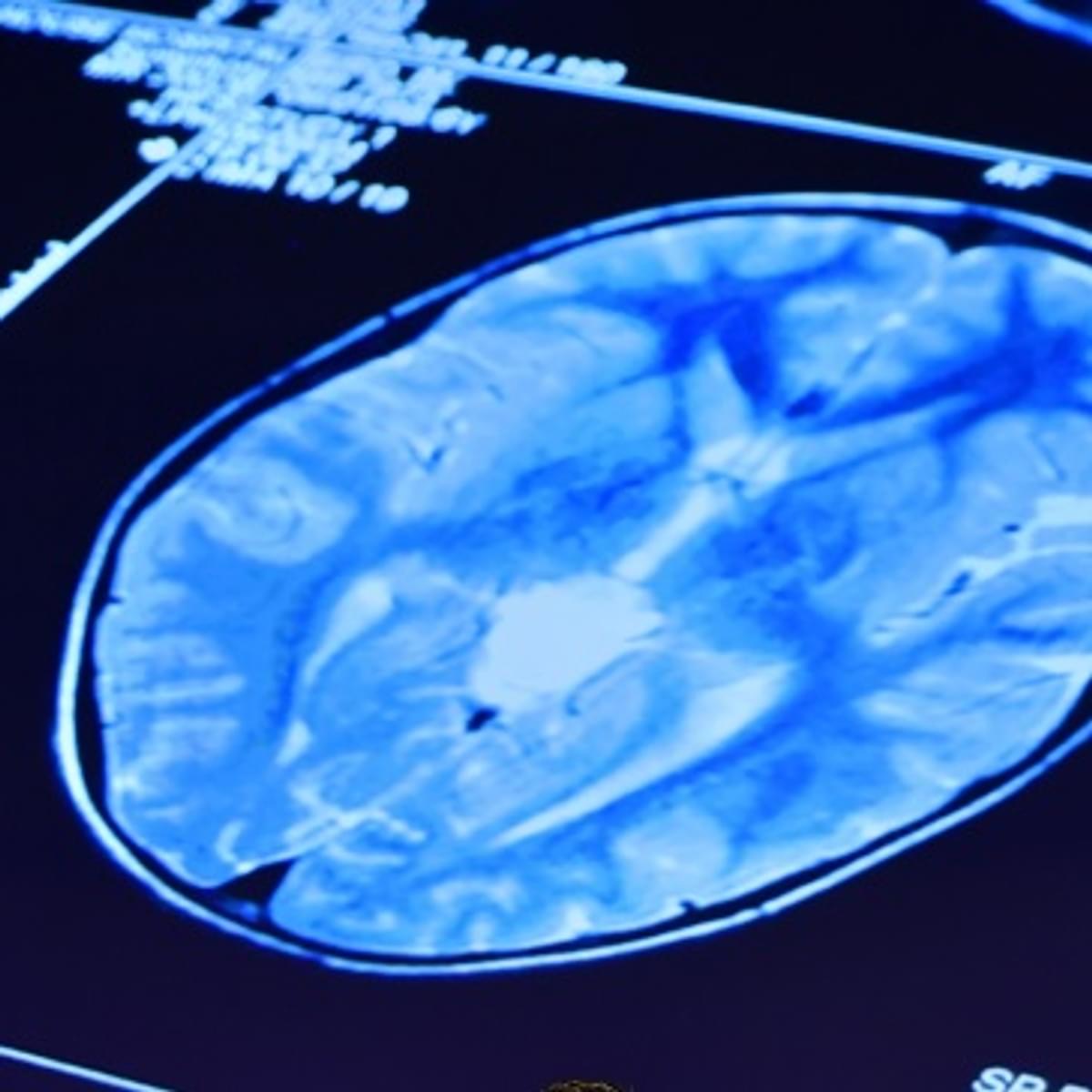 HPE technologie versnelt onderzoek naar Alzheimer image
