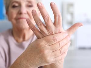 Arthritis Flare Up