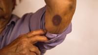 Elderly Woman with a Bruised Arm