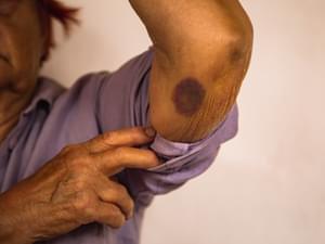 Elderly Woman with a Bruised Arm