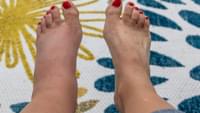 Swollen Feet Comparison