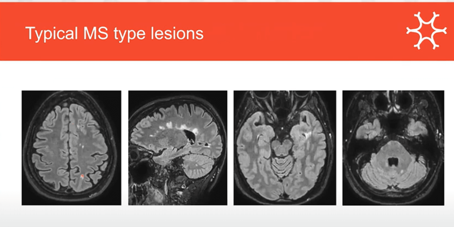 Radiologically-isolated syndrome | Neurology Academy