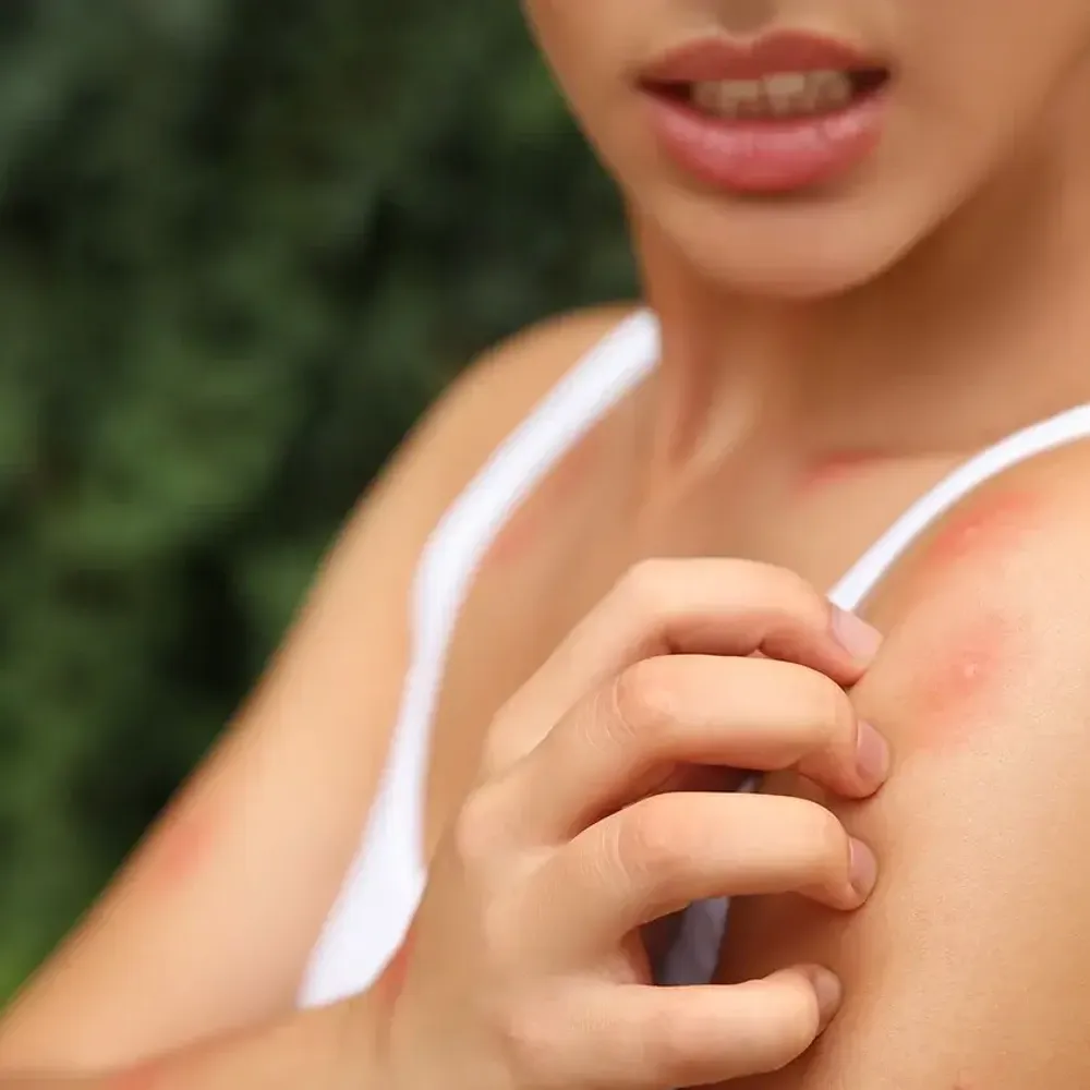 Why do mosquito bites cause different reactions?