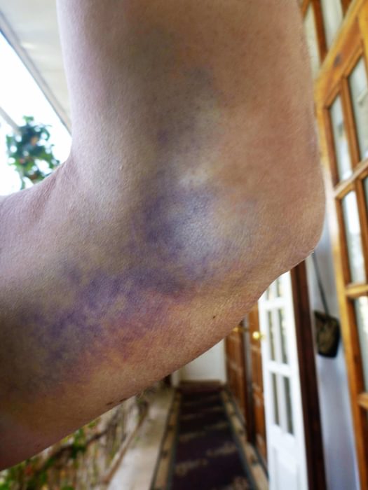 Sore Arm In Uzbekistan After Minor Accident